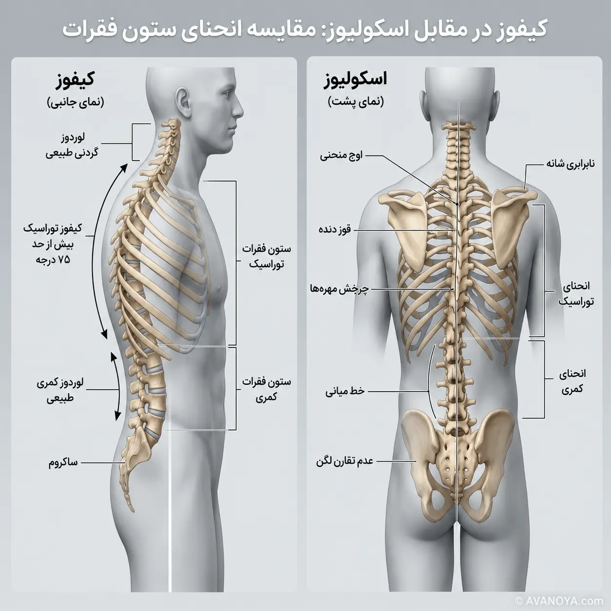 تصویر مقایسه‌ای تفاوت میان قوز پشتی (کایفوز) و انحراف جانبی ستون فقرات (اسکولیوز)